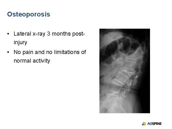 Osteoporosis • Lateral x-ray 3 months postinjury • No pain and no limitations of