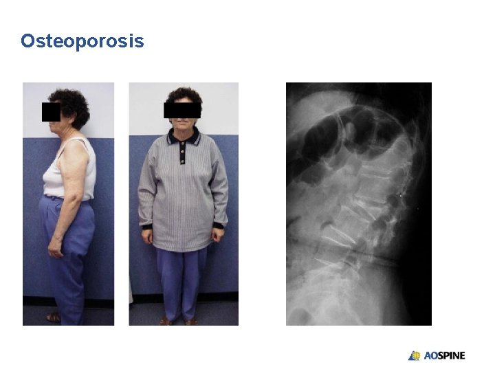 Osteoporosis 