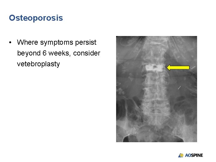 Osteoporosis • Where symptoms persist beyond 6 weeks, consider vetebroplasty 
