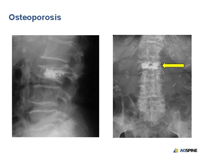 Osteoporosis 