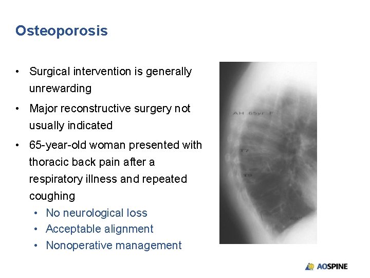 Osteoporosis • Surgical intervention is generally unrewarding • Major reconstructive surgery not usually indicated