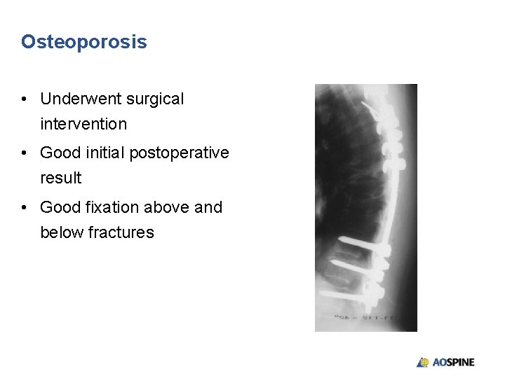 Osteoporosis • Underwent surgical intervention • Good initial postoperative result • Good fixation above