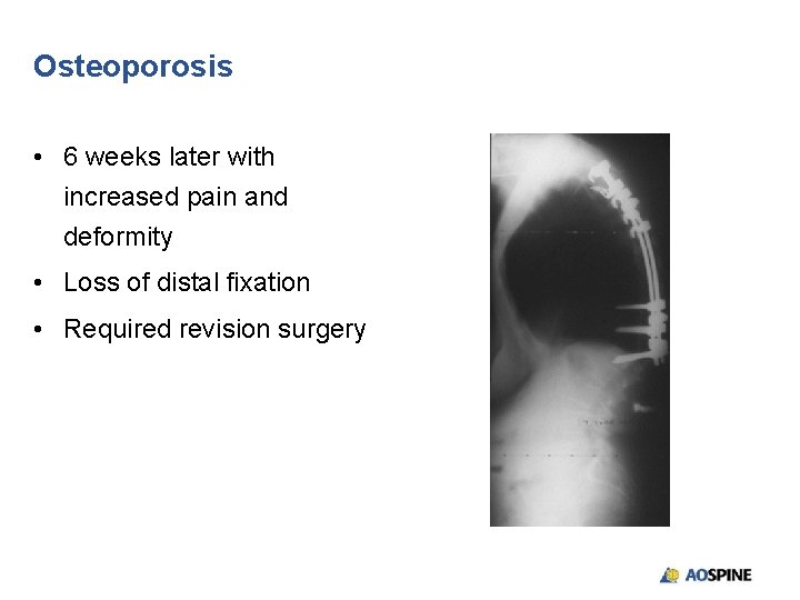 Osteoporosis • 6 weeks later with increased pain and deformity • Loss of distal