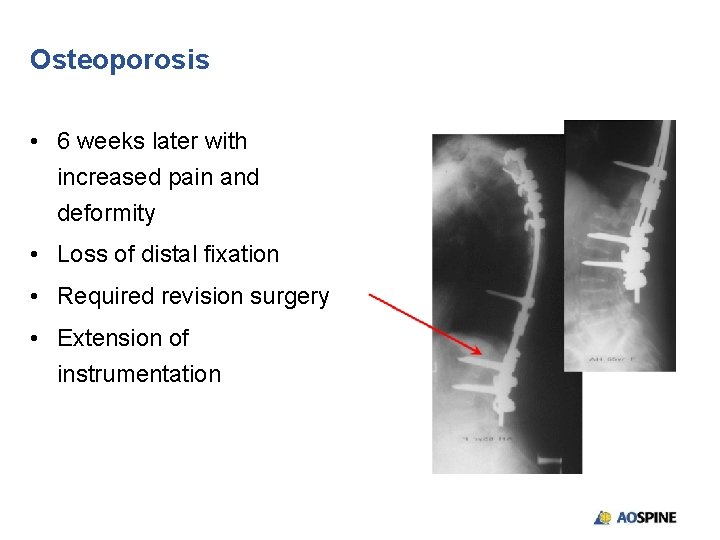 Osteoporosis • 6 weeks later with increased pain and deformity • Loss of distal