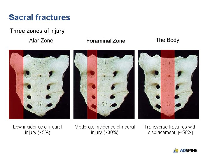 Sacral fractures Three zones of injury Low incidence of neural injury (~5%) Moderate incidence