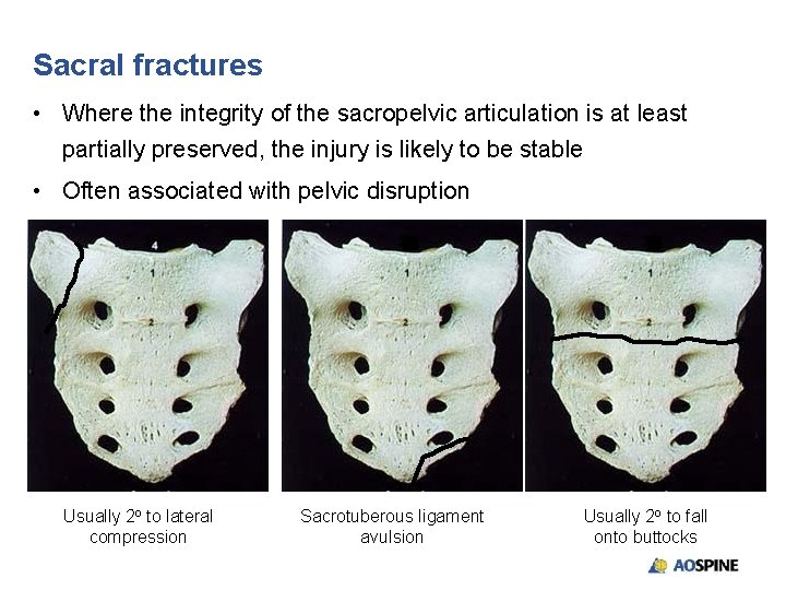 Sacral fractures • Where the integrity of the sacropelvic articulation is at least partially