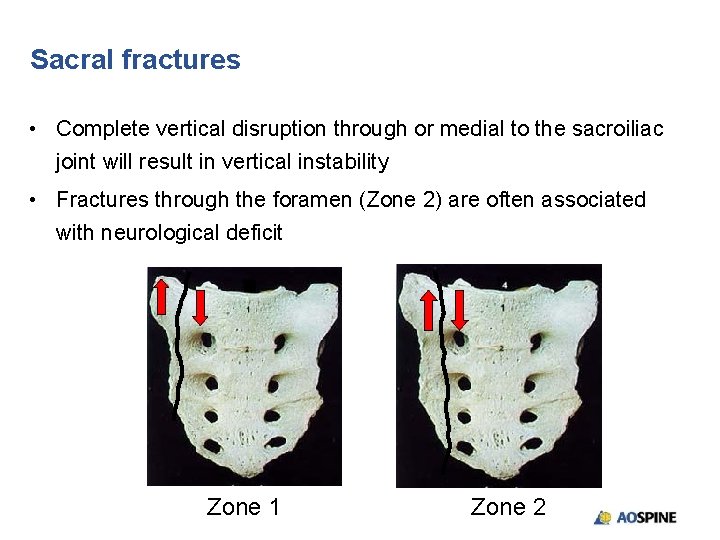 Sacral fractures • Complete vertical disruption through or medial to the sacroiliac joint will