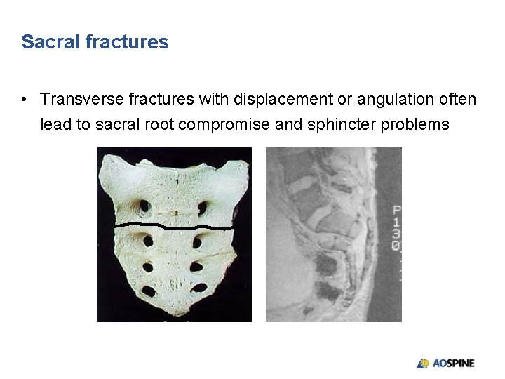 Sacral fractures • Transverse fractures with displacement or angulation often lead to sacral root