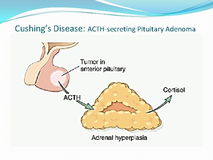 Cushing’s Disease: ACTH-secreting Pituitary Adenoma 
