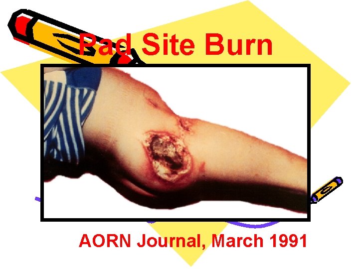 Pad Site Burn AORN Journal, March 1991 