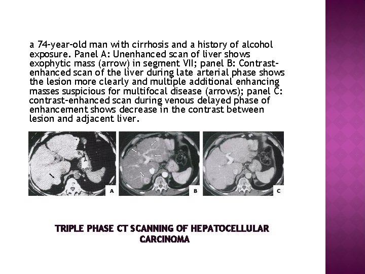 a 74 -year-old man with cirrhosis and a history of alcohol exposure. Panel A: