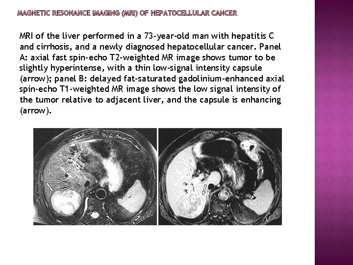 MRI of the liver performed in a 73 -year-old man with hepatitis C and