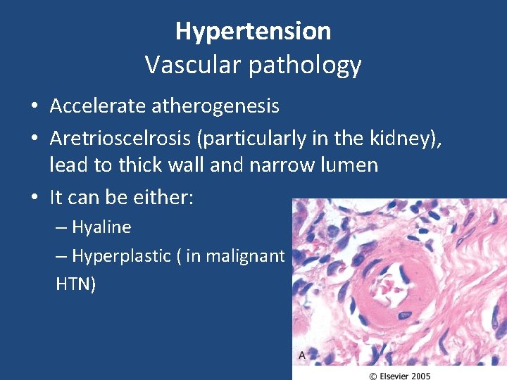 Hypertension Vascular pathology • Accelerate atherogenesis • Aretrioscelrosis (particularly in the kidney), lead to