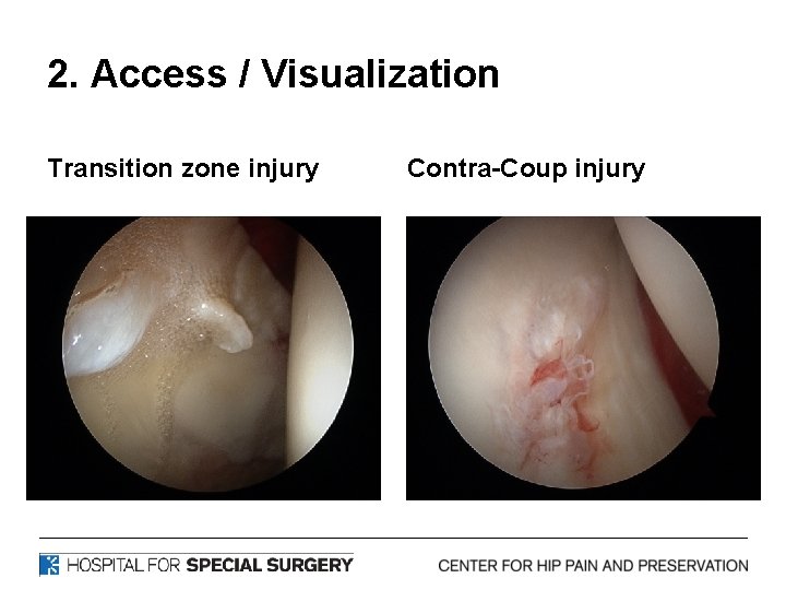 2. Access / Visualization Transition zone injury Contra-Coup injury 