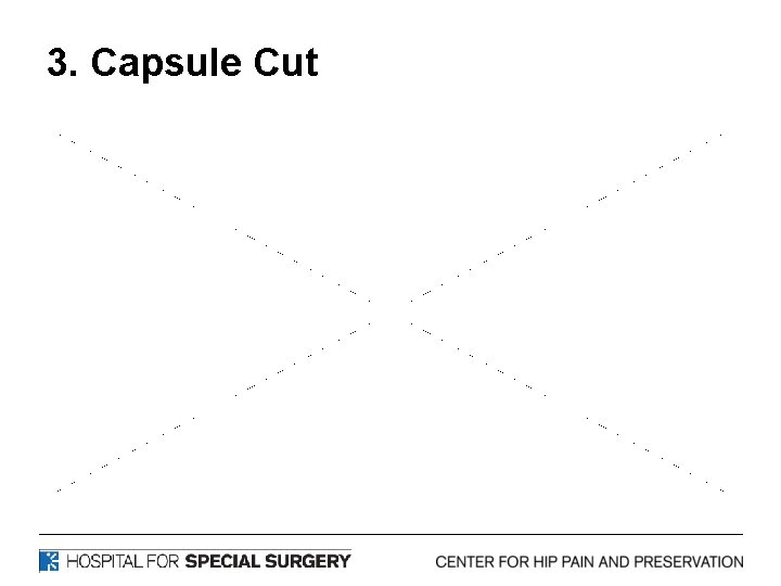 3. Capsule Cut 