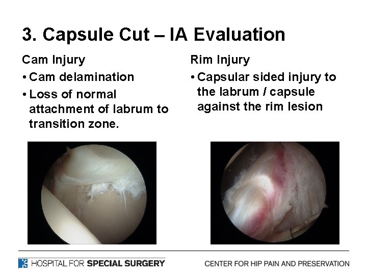 3. Capsule Cut – IA Evaluation Cam Injury • Cam delamination • Loss of