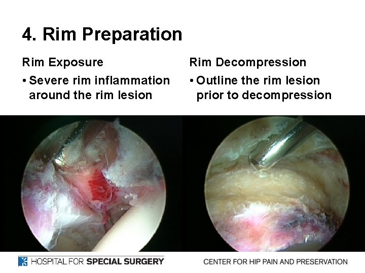 4. Rim Preparation Rim Exposure Rim Decompression • Severe rim inflammation around the rim