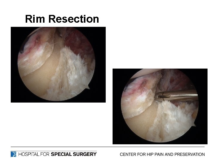3. Rim Resection 