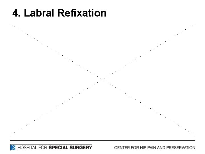 4. Labral Refixation 