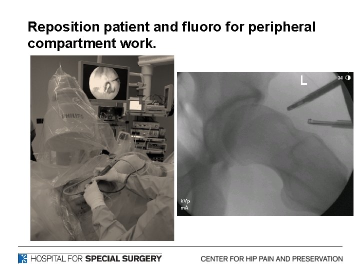 Reposition patient and fluoro for peripheral compartment work. 