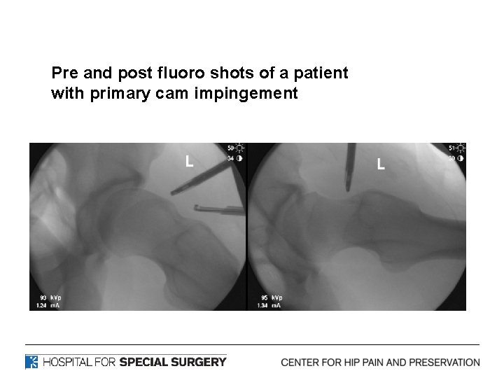 Pre and post fluoro shots of a patient with primary cam impingement 