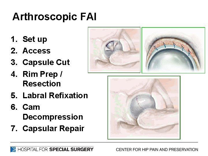 Arthroscopic FAI 1. 2. 3. 4. Set up Access Capsule Cut Rim Prep /