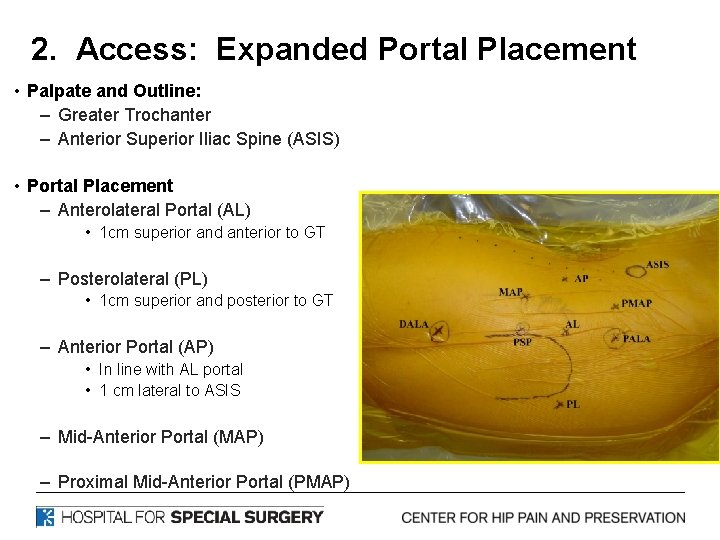 2. Access: Expanded Portal Placement • Palpate and Outline: – Greater Trochanter – Anterior