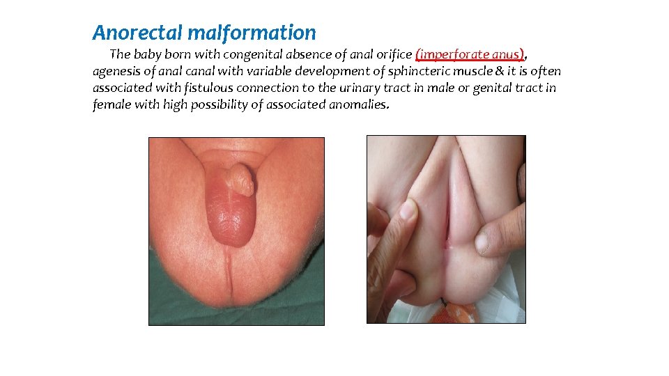 Anorectal malformation The baby born with congenital absence of anal orifice (imperforate anus), agenesis