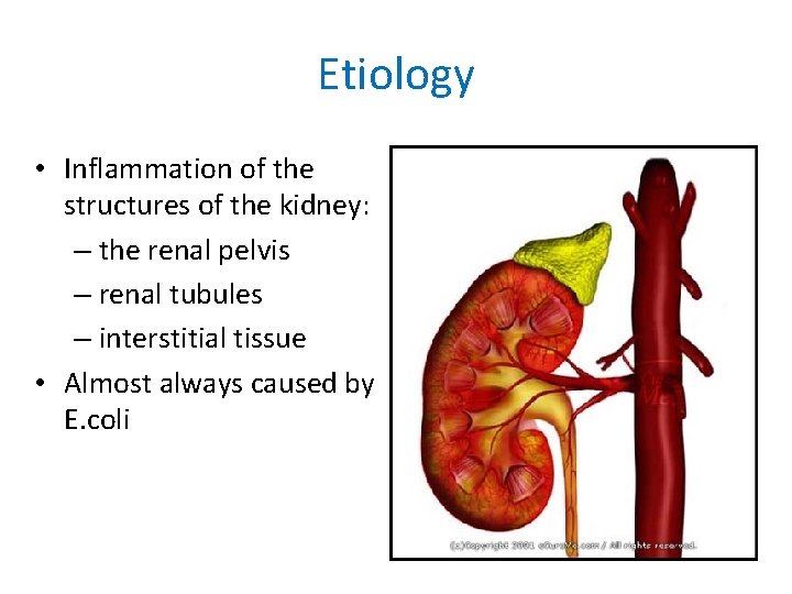 Etiology • Inflammation of the structures of the kidney: – the renal pelvis –