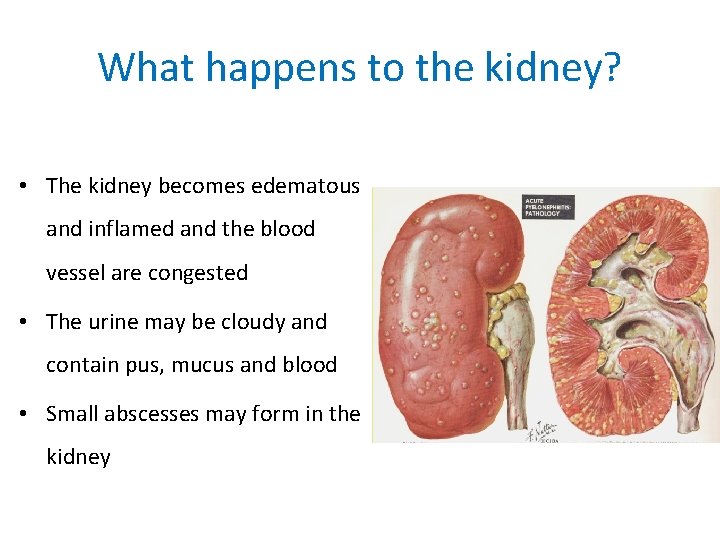 What happens to the kidney? • The kidney becomes edematous and inflamed and the