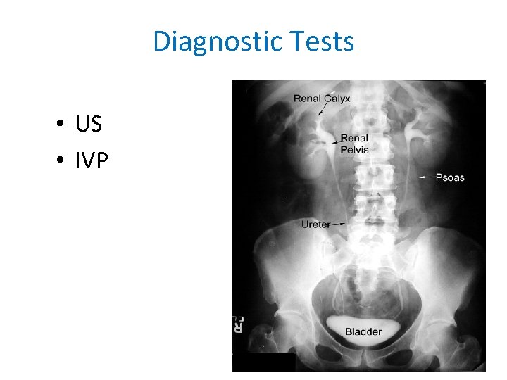 Diagnostic Tests • US • IVP 