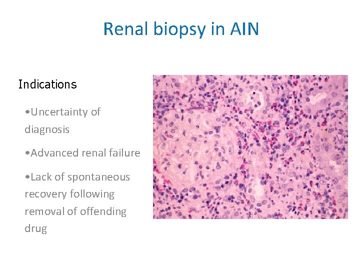 Renal biopsy in AIN Indications • Uncertainty of diagnosis • Advanced renal failure •