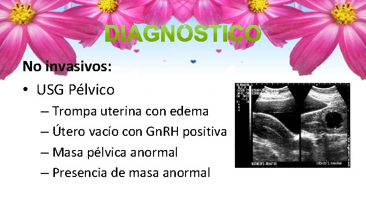 No invasivos: • USG Pélvico – Trompa uterina con edema – Útero vacío con