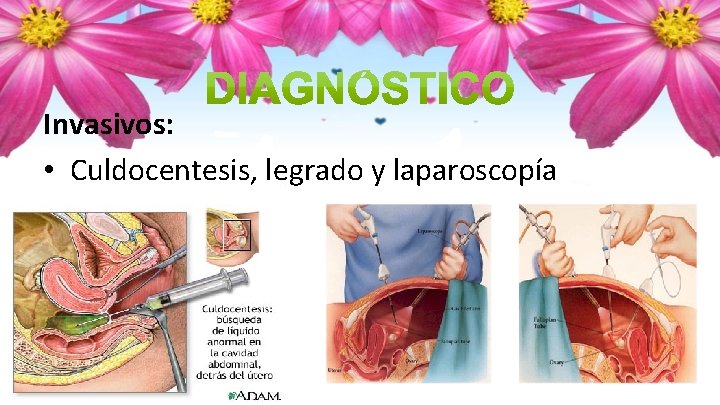 Invasivos: • Culdocentesis, legrado y laparoscopía 