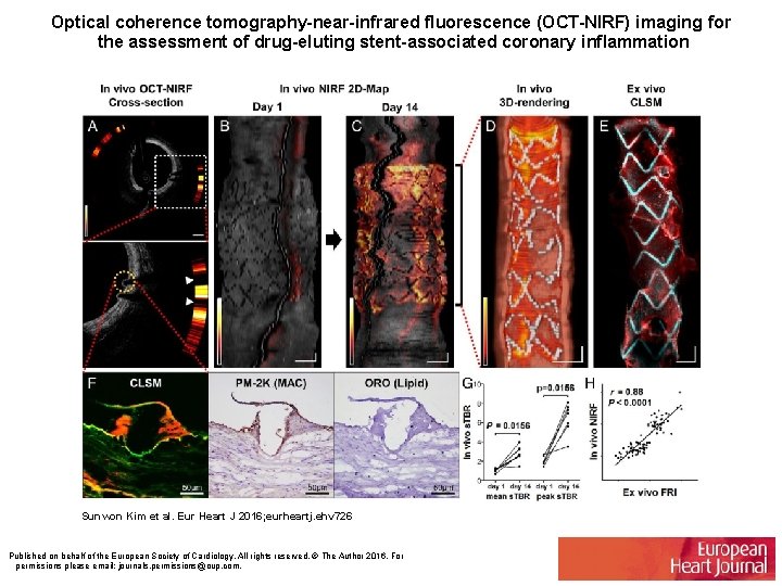 Optical coherence tomography-near-infrared fluorescence (OCT-NIRF) imaging for the assessment of drug-eluting stent-associated coronary inflammation