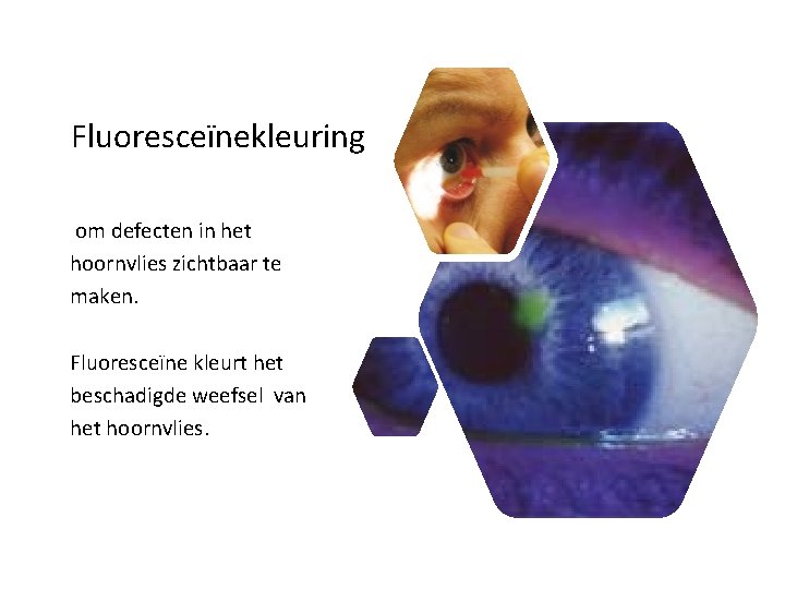 Fluoresceïnekleuring om defecten in het hoornvlies zichtbaar te maken. Fluoresceïne kleurt het beschadigde weefsel