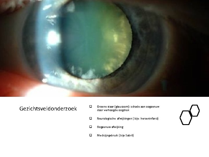 Gezichtsveldonderzoek q Groene staar (glaucoom): schade aan oogzenuw door verhoogde oogdruk q Neurologische afwijkingen