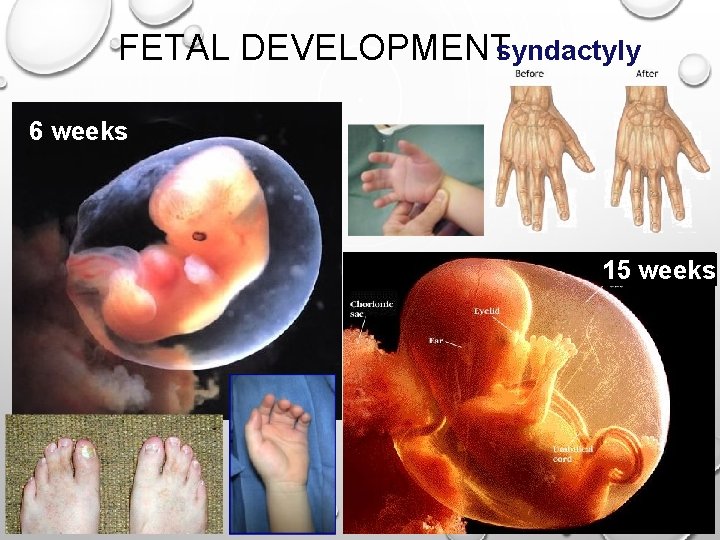 FETAL DEVELOPMENTsyndactyly 6 weeks 15 weeks 