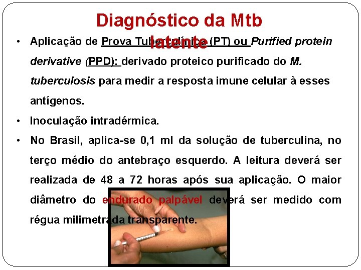  • Diagnóstico da Mtb Aplicação de Prova Tuberculínica latente (PT) ou Purified protein