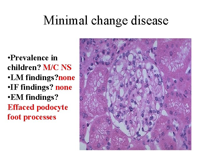 Minimal change disease • Prevalence in children? M/C NS • LM findings? none •