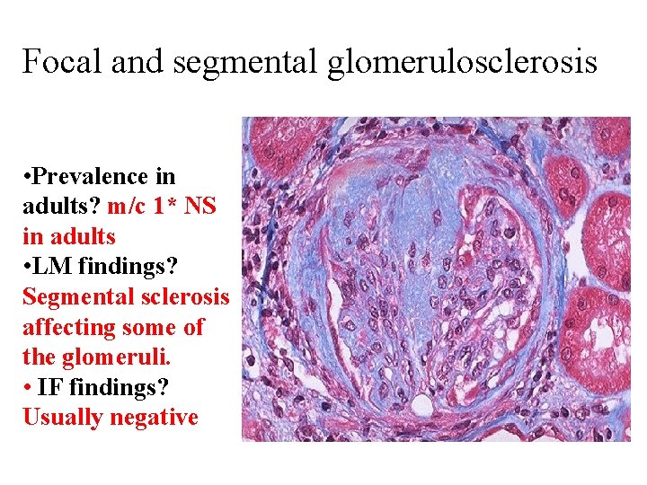 Focal and segmental glomerulosclerosis • Prevalence in adults? m/c 1* NS in adults •