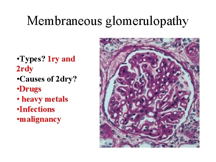 Membraneous glomerulopathy • Types? 1 ry and 2 rdy • Causes of 2 dry?