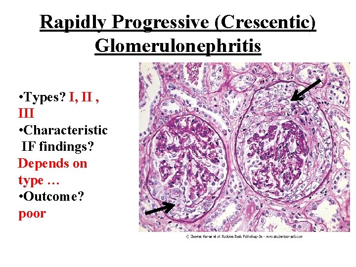 Rapidly Progressive (Crescentic) Glomerulonephritis • Types? I, III • Characteristic IF findings? Depends on