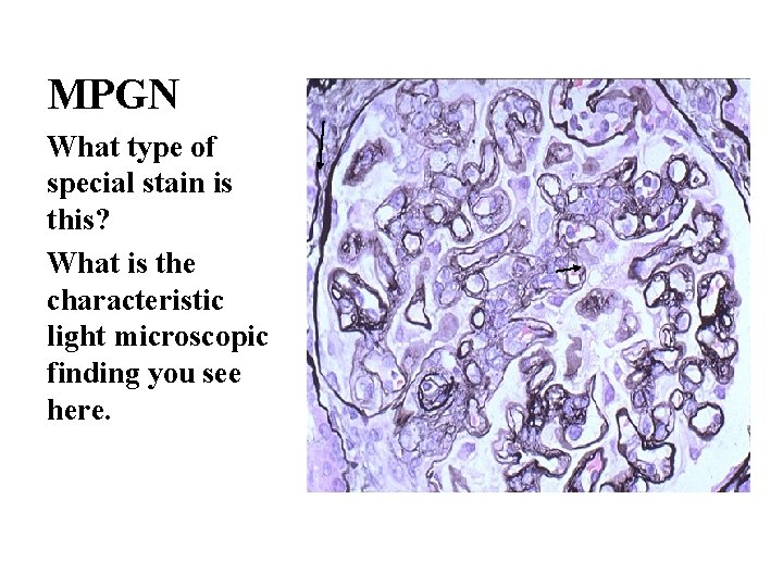 MPGN What type of special stain is this? What is the characteristic light microscopic