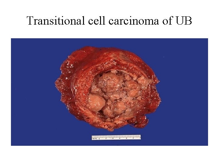 Transitional cell carcinoma of UB 