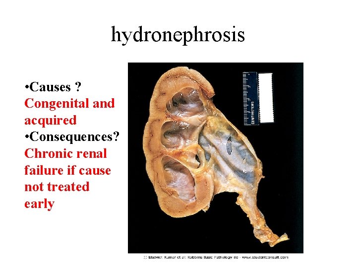 hydronephrosis • Causes ? Congenital and acquired • Consequences? Chronic renal failure if cause