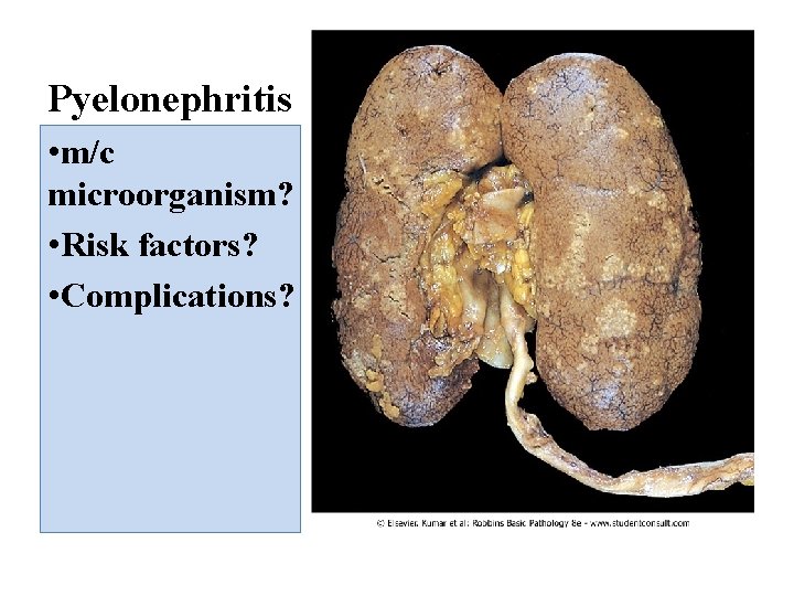 Pyelonephritis • m/c microorganism? • Risk factors? • Complications? 