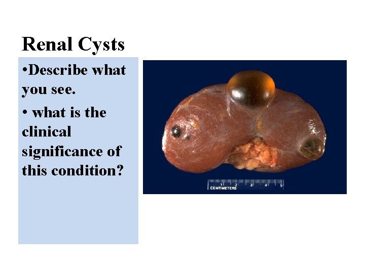 Renal Cysts • Describe what you see. • what is the clinical significance of