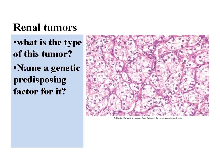 Renal tumors • what is the type of this tumor? • Name a genetic