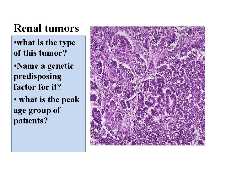 Renal tumors • what is the type of this tumor? • Name a genetic